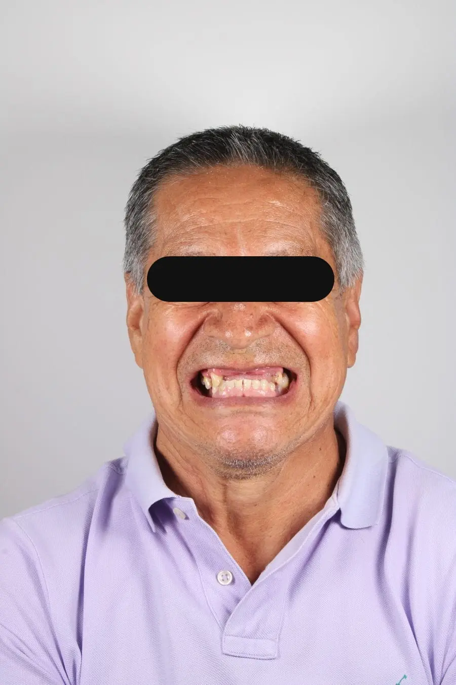 Prótesis parcial removible: antes del tratamiento